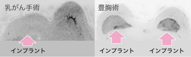 MRI検査