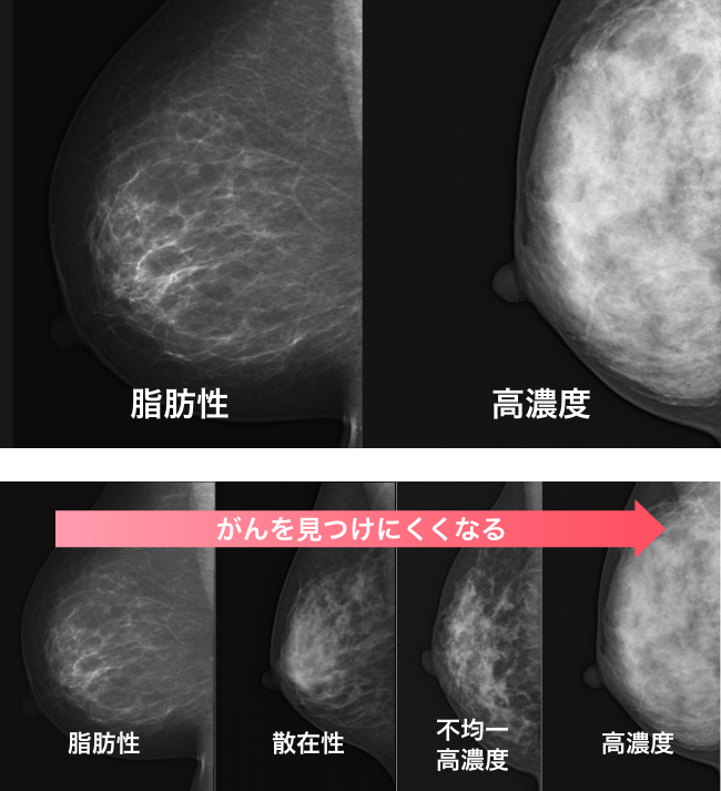 MRI日本人に適している理由 / 大切な人へ健康を贈る- MRI乳がん検診ギフト